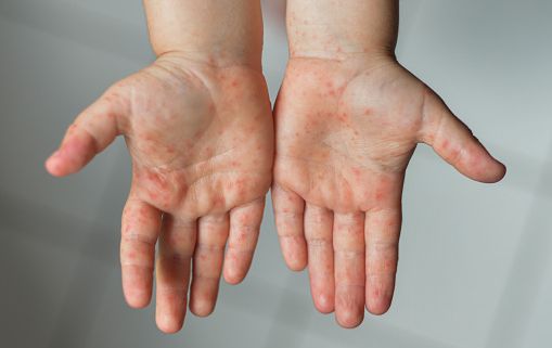 Emite aviso epidemiológico por sarampión